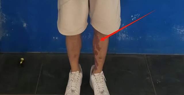 星全身照腿部伤痕惊心更多受害家属发声九游会J9入口营救神速！泰方公布星(图7)